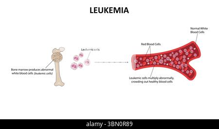 Leukemia vector illustration Stock Vector
