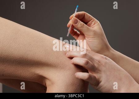 concept dry needling method. Acupuncture treatment close-up. Therapist inserting a thin needle into patient's skin for alternative therapy, pain relie Stock Photo
