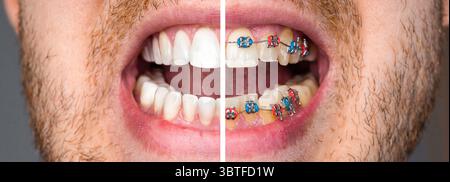 Closeup man with teeth before and after braces treatment. Dental braces, correcting teeth Stock Photo
