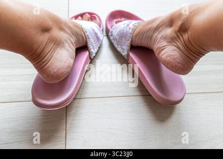 Dry cracked heels in pink slippers. Close-up of dry, cracked heels in sparkly pink slippers on tiled floor, showing foot skin condition and lack of Stock Photo