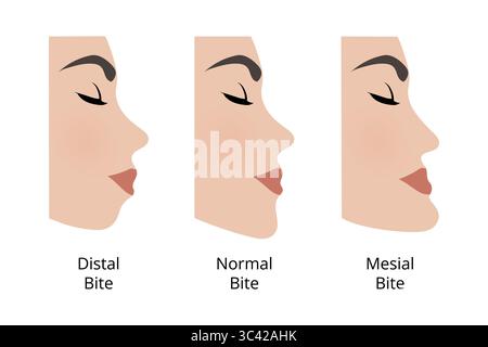 Medical illustration showing three different types of dental occlusion, comparing distal bite, normal bite and mesial bite, useful for explaining unde Stock Vector