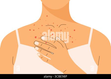 woman with skin rash, allergic reaction on her neckline; ideal for medical, dermatological, and allergy-related educational or promotional content- ve Stock Vector