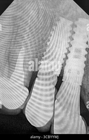 Dental implants and tooth. Black and white x-ray image. Stock Photo