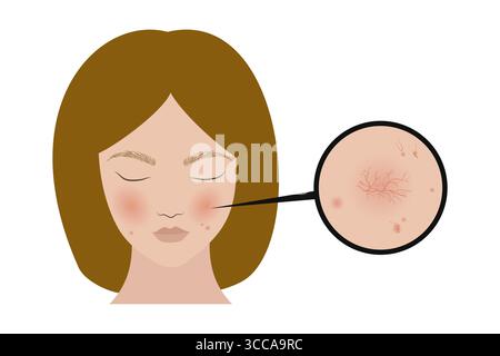 Woman showing rosacea symptoms on face skin Stock Vector