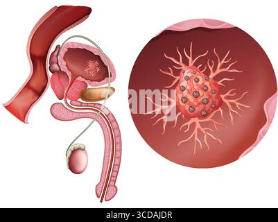 Diagram of prostate cancer illustration Stock Vector Image & Art - Alamy
