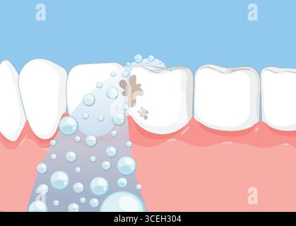 Vector illustration of a water flosser removing plaque from between white teeth, using flat design, soft colors, and clear dental anatomy Stock Vector