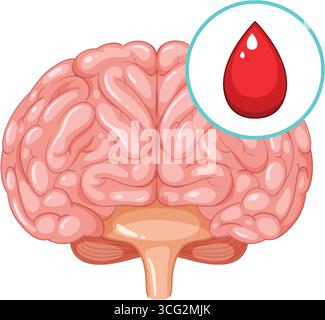 Diagram of human brain hemorrhage illustration Stock Vector Image & Art ...