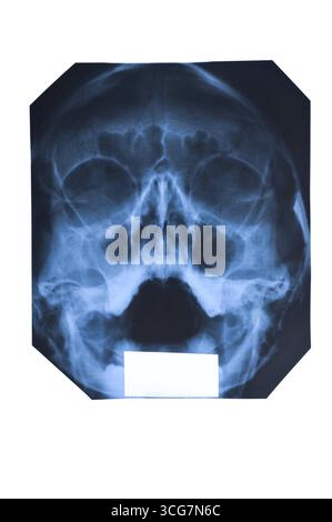 X-ray of face and maxillary sinuses isolated on white Stock Photo