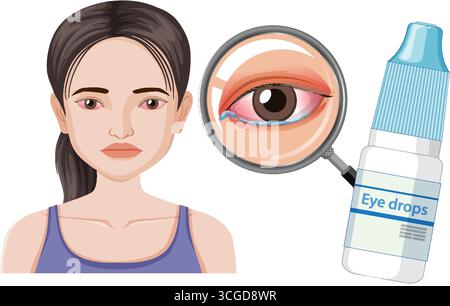 Vector illustration of woman with red, irritated eyes, magnified eye detail, and eye drops. Stock Vector