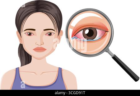 Vector illustration of woman with red, irritated eyes under magnifying glass, highlighting eye inflammation. Stock Vector