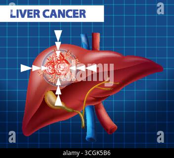 Close up diagram of liver anatomy illustration Stock Vector Image & Art ...