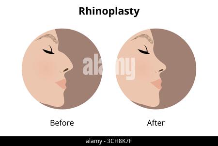 Profile view of a woman face highlighting the transformation before and after rhinoplasty, illustrating the change in nose shape from a popular cosmet Stock Vector