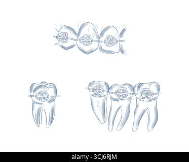 Teeth with braces set illustration drawing in graphic style with blue on white background. Stock Vector