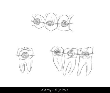 Teeth with braces set illustration drawing in graphic style with black on white background. Stock Vector