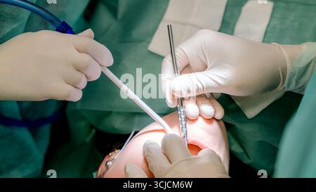 Close-up of a dental grafting procedure, showing a dentist's gloved hands performing oral surgery. The focus is on precision and professional dental c Stock Photo