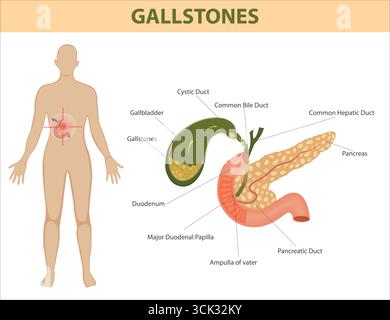 Medical illustration of gallstones in the gallbladder and their anatomical relation to liver, pancreas, ducts, and duodenum. Stock Vector