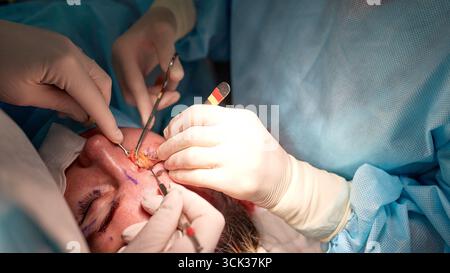 Surgeons are seen conducting a detailed blepharoplasty, focusing on precision and care. The image represents a clinical display of skill and teamwork Stock Photo