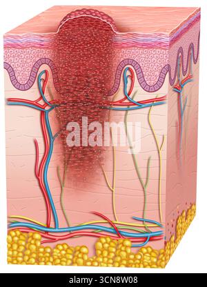 Illustration of skin with advanced stage melanoma. Stage IV melanoma is ...