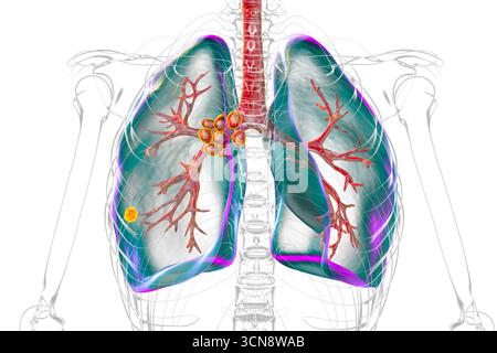 Illustration of primary lung tuberculosis with the Ranke complex ...