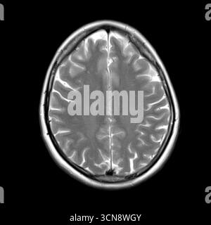 Axial T2-weighted magnetic resonance image (MRI) scan of a 40-year-old ...