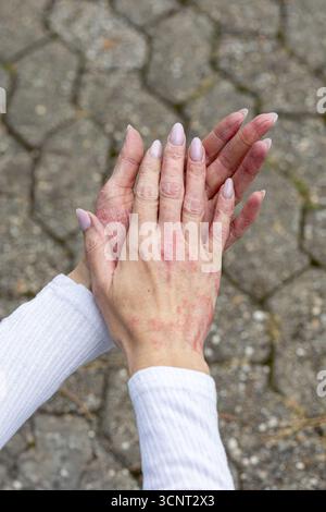 Two hands showing signs of eczema and psoriasis are clasped together on a stone path. The skin shows redness and dryness, while the backdrop includes Stock Photo