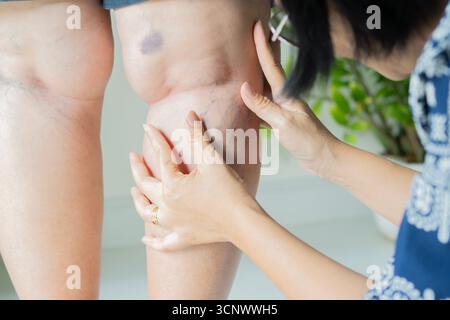 Cropped shot of senior woman with varicose veins getting physical therapy treatment at home. Selective focus. Stock Photo
