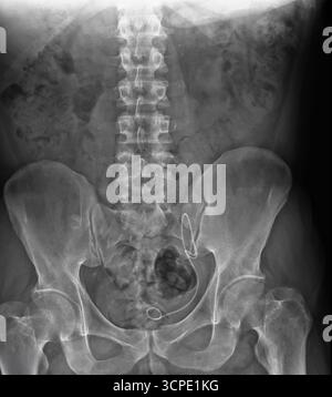 X-ray of lumbar spine and pelvis showing bones and joints with medical ...