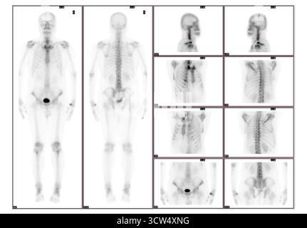 Whole body bone scan was performed following intravenous injection