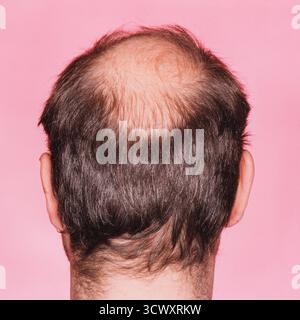 Nahaufnahme eines Hinterkopfs eines Mannes mit einer deutlichen Glatze oder Haarausfall *** Close-up of the back of a mans head with significant baldn Stock Photo