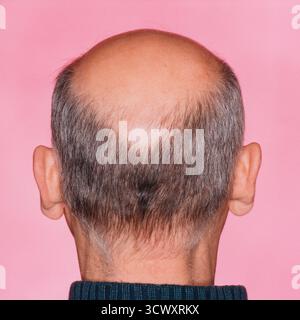 Nahaufnahme eines Hinterkopfs eines Mannes mit einer deutlichen Glatze oder Haarausfall *** Close-up of the back of a mans head with significant baldn Stock Photo