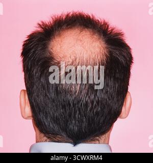 Nahaufnahme eines Hinterkopfs eines Mannes mit einer deutlichen Glatze oder Haarausfall *** Close-up of the back of a mans head with significant baldn Stock Photo