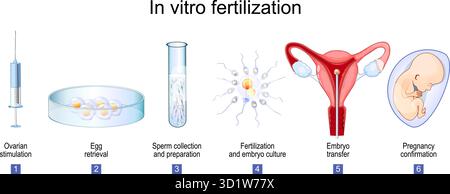 IVF Treatment Steps with In Vitro Fertilization Concept. Vector ...