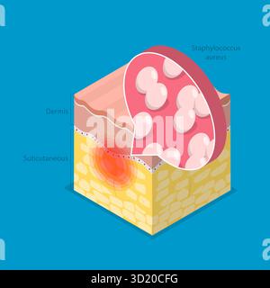Clostridium botulinum bacteria, illustration. Clostridium botulinum is ...