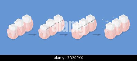 3D Isometric Flat Illustration of Dental Teeth Braces Types ...