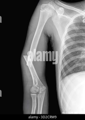 X-ray of a fractured humerus (upper arm bone). This is a pathological ...