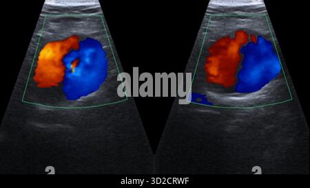 Abdominal aortic aneurysm. Ultrasound scan of the abdomen of a 83 year ...