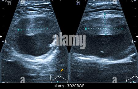 Abdominal aortic aneurysm. Ultrasound scan of the abdomen of a 83 year ...