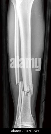 X-ray of fractures of the tibia (shinbone) and fibula (calf bone). Stock Photo