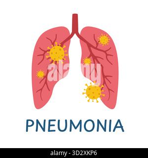 concept of pneumonia; virus and bacteria infecting human lungs; perfect for for healthcare, medicine, and science visuals- vector illustration Stock Vector