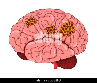Glioblastoma. Brain tumor. Malignant cancer. Vector illustration Stock ...