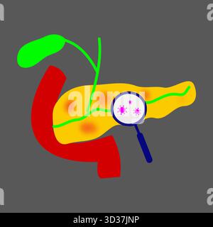 pancreatic infection inflammation zoomed in lens magnifying glass indicating presence of infection micro organisms Stock Vector