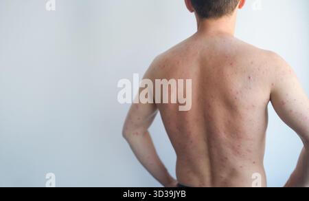 Pinpoint Rash Allergy The arm of man with rash on, symptoms of itching, skin allergy Stock ...