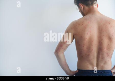 Chest Rashes In Men Skin reaction on a man chest after chemotherapy. Allergic reaction ...