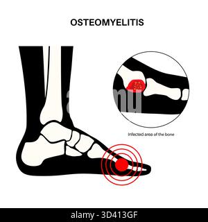 illustration-of-foot-bone-osteomyelitis-this-is-an-infection-of-a-bone