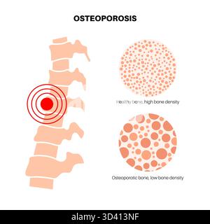 Osteoporosis disease poster. Systemic skeletal disorder of spine, wrist ...