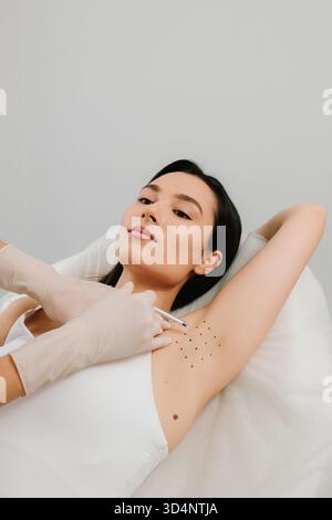 Hyperhidrosis injection for underarm. Intradermal injection procedure ...