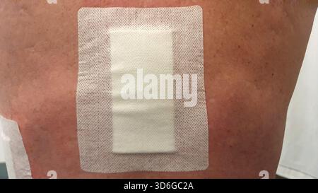 lose-up medical image of a human back with surgical dressings, fresh scars, and postoperative stitches. Ideal for themes related to surgery recovery, Stock Photo