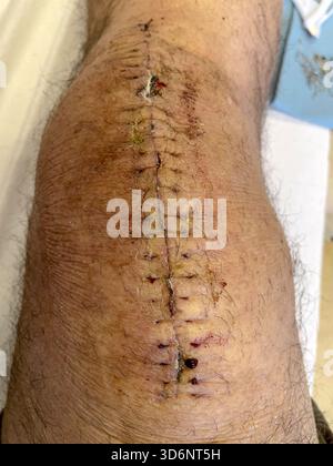 Clinical removal of surgical staples from a healing knee incision ...