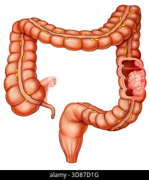 Colorectal cancer, malignant tumor in intestine, Endoscope inside ...