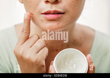 A young Asian woman reflecting on mirror for skincare treatment, applying medicative ointment cream on burn marks on her face, hand holding cream jar Stock Photo